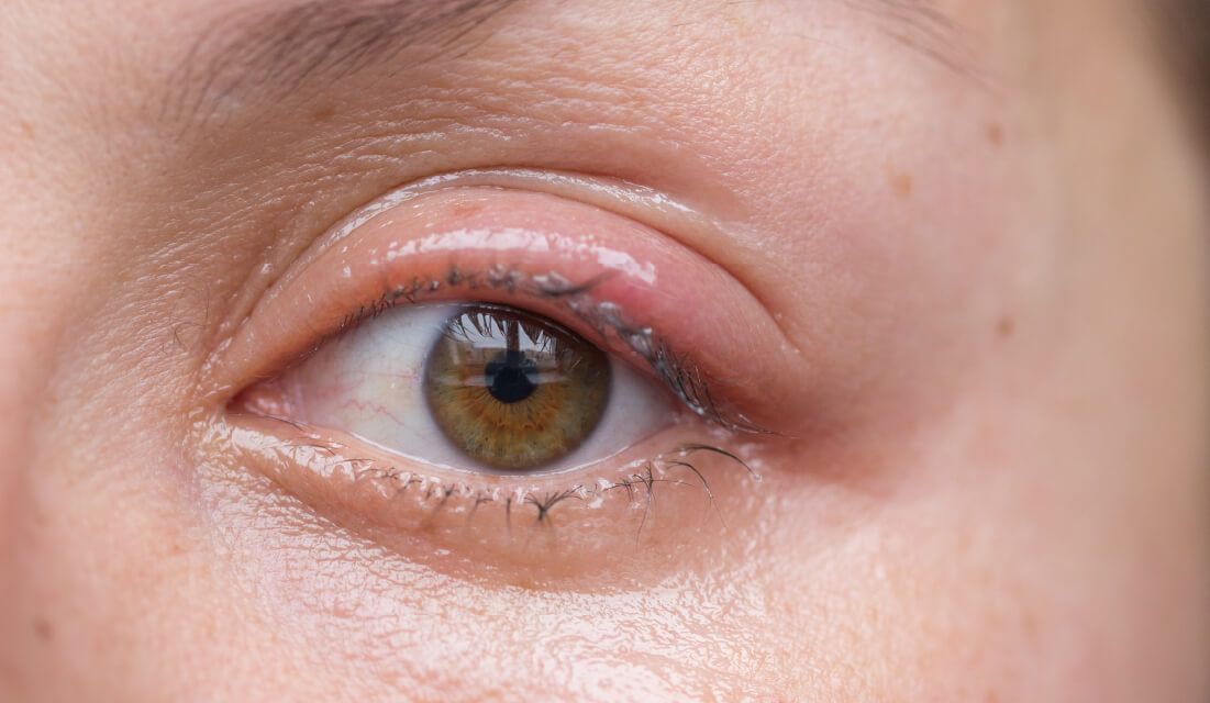 can you wear eye makeup with blepharitis